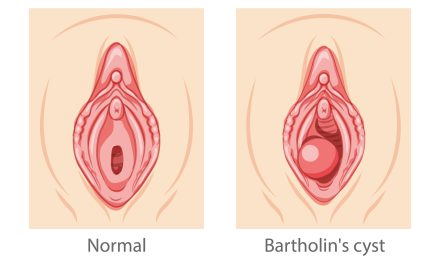 Bartolinijeva cista – uzrok, simptomi, liječenje