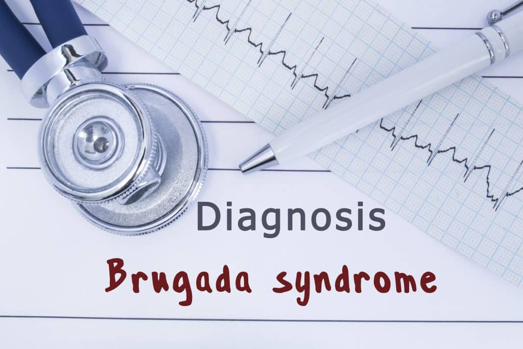 Brugada sindrom - uzrok, simptomi, liječenje