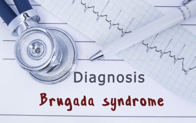 Brugada sindrom – uzrok, simptomi, liječenje