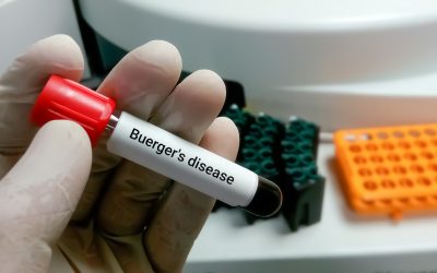 Buergerova bolest – uzrok, simptomi, liječenje