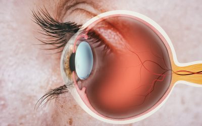 Centralna serozna retinopatija – uzrok, simptomi, liječenje
