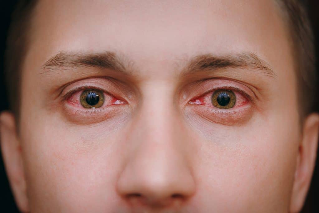 Crveno oko - uzrok, simptomi, liječenje