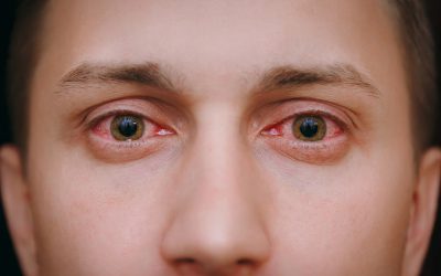 Crveno oko – uzrok, simptomi, liječenje