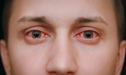 Crveno oko – uzrok, simptomi, liječenje