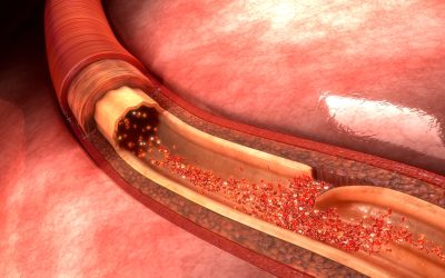 Disekcija aorte – uzrok, simptomi, liječenje