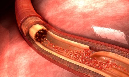 Disekcija aorte – uzrok, simptomi, liječenje