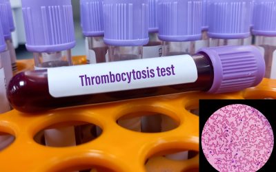 Esencijalna trombocitoza – uzrok, simptomi, liječenje