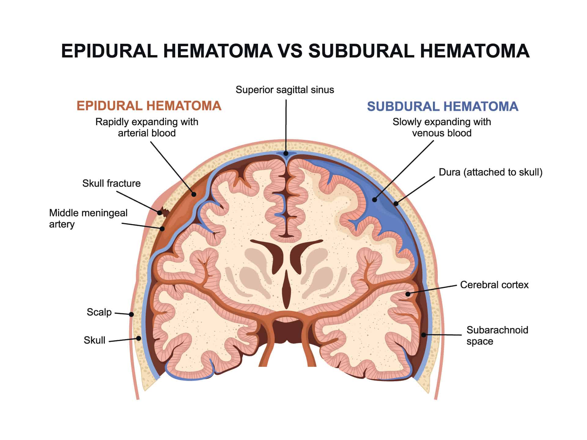 Epiduralni Hematom Uzrok Simptomi Lije enje Arz hr epiduralni-hematom-uzrok-simptomi-lije-enje-arz-hr