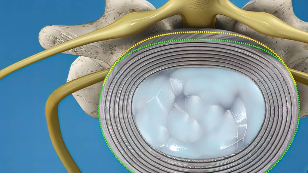Iskliznuće diska - uzrok, simptomi, liječenje