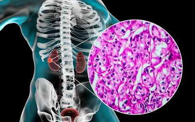 Karcinom bubrežnih stanica – uzrok, simptomi, liječenje