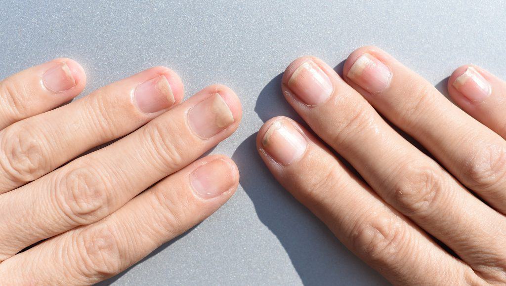 Oniholiza - odvajanje nokta od podloge - uzrok, simptomi, liječenje