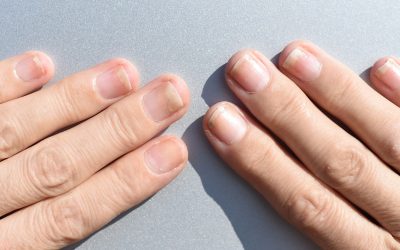 Oniholiza – odvajanje nokta od podloge – uzrok, simptomi, liječenje