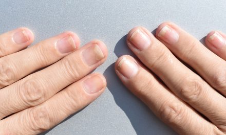Oniholiza – odvajanje nokta od podloge – uzrok, simptomi, liječenje