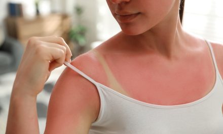 Opekline od sunca – uzrok, simptomi, liječenje