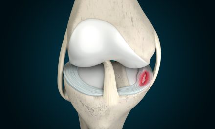 Ozljede meniska koljena – uzrok, simptomi, liječenje