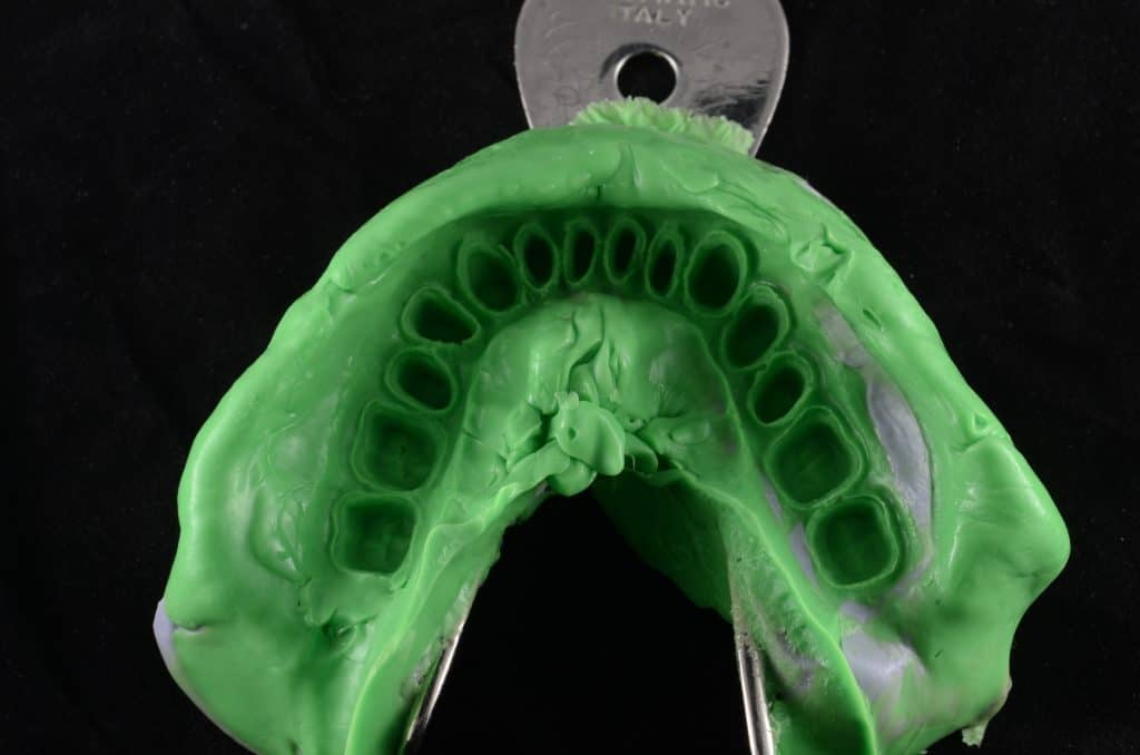 Plummer-Vinsonov sindrom - uzrok, simptomi, liječenje