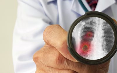 Pneumonije uzrokovane respiratornim virusima – uzrok, simptomi, liječenje
