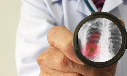 Pneumonije uzrokovane respiratornim virusima – uzrok, simptomi, liječenje