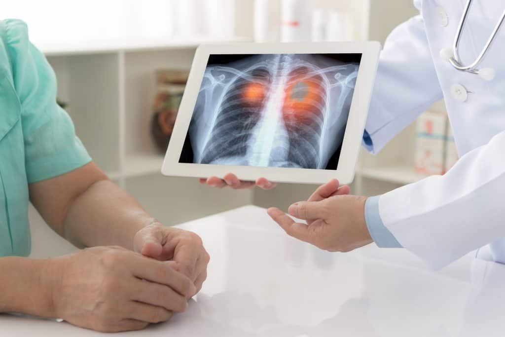 Rak pluća - uzrok, simptomi, liječenje