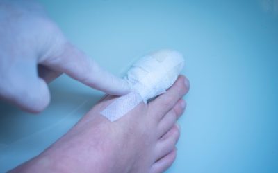 Slomljeni nožni prst – uzrok, simptomi, liječenje
