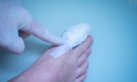 Slomljeni nožni prst – uzrok, simptomi, liječenje