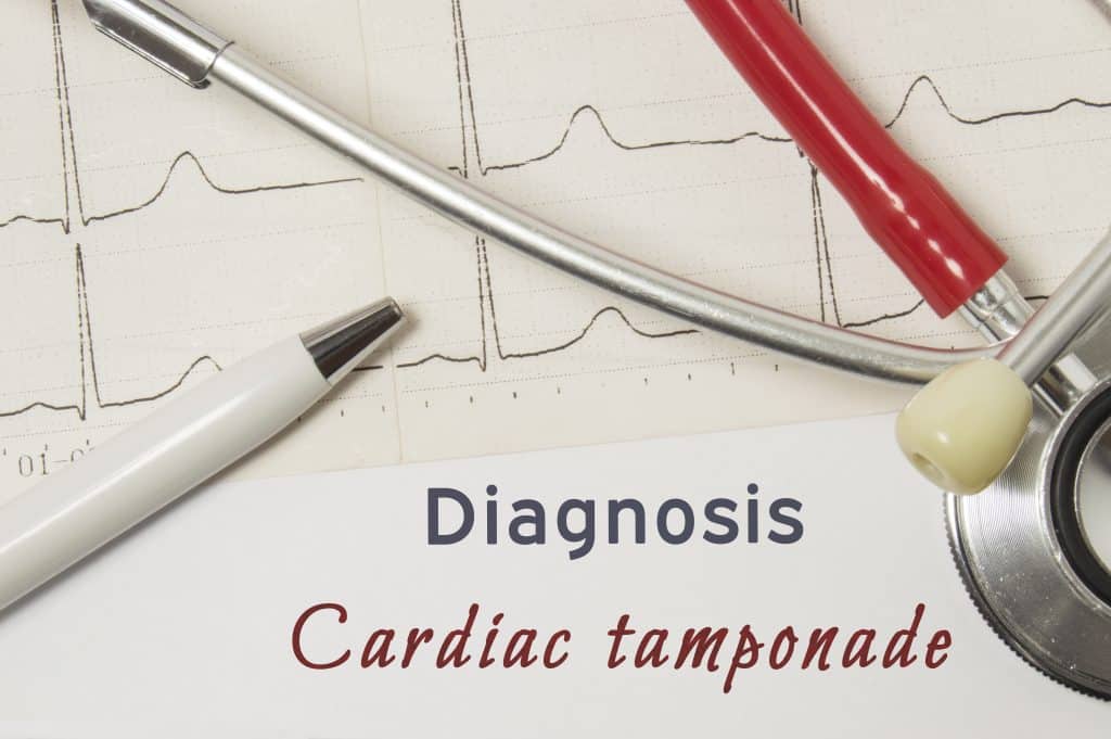 Srčana tamponada - uzrok, simptomi, liječenje