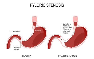 Stenoza pilorusa – uzrok, simptomi, liječenje