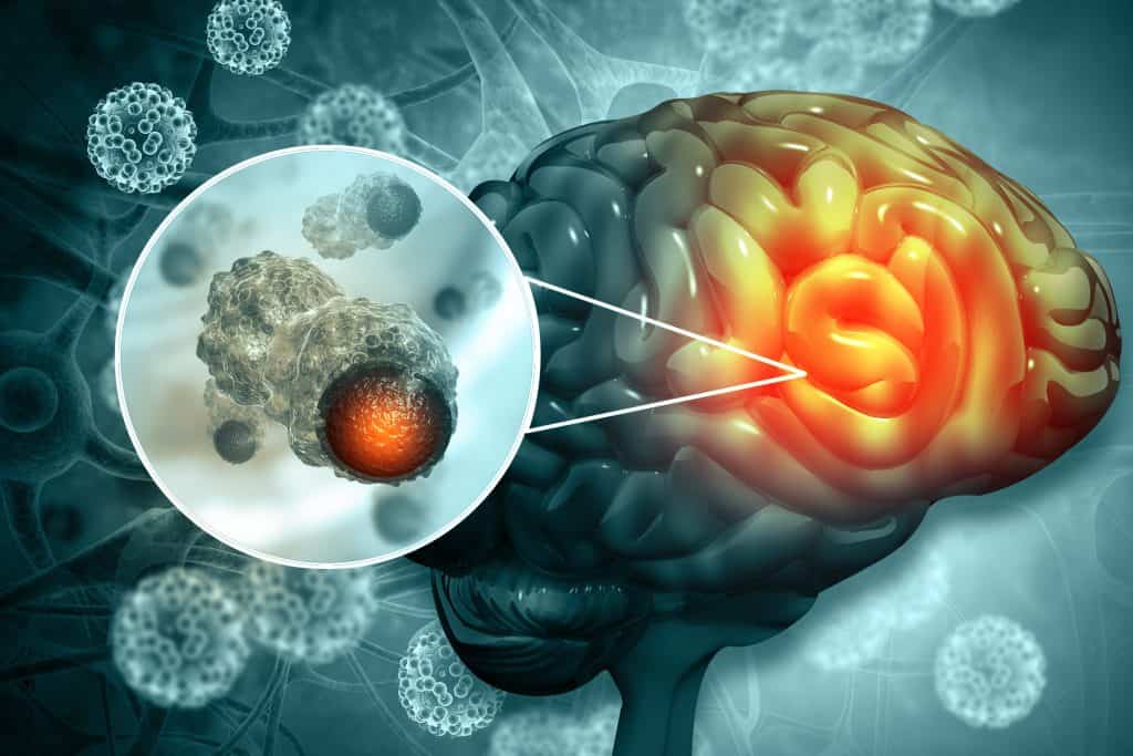 Tumori mozga - uzrok, simptomi, liječenje