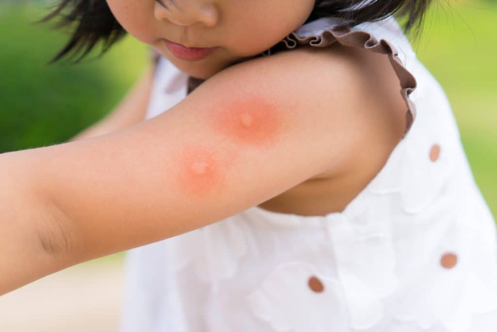 Ubodi komaraca - simptomi i liječenje