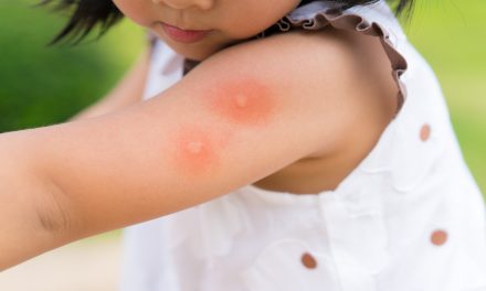 Ubodi komaraca – simptomi i liječenje