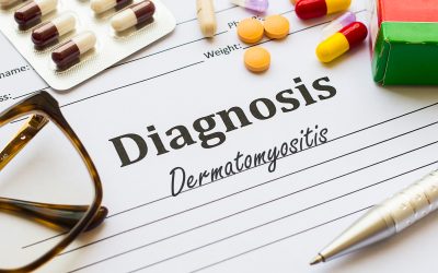 Dermatomiozitis – uzrok, simptomi, liječenje