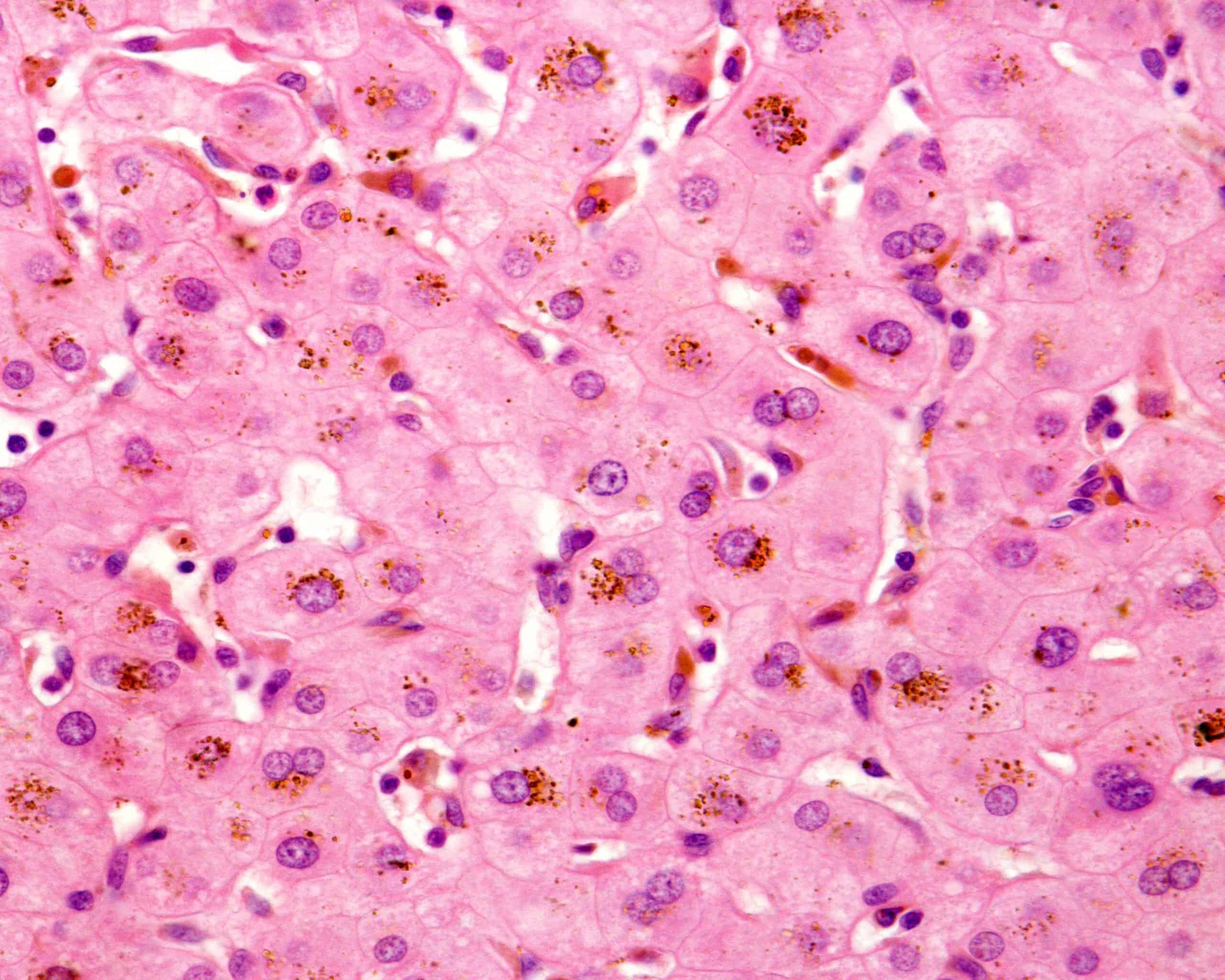 Što je kolestaza Arz.hr