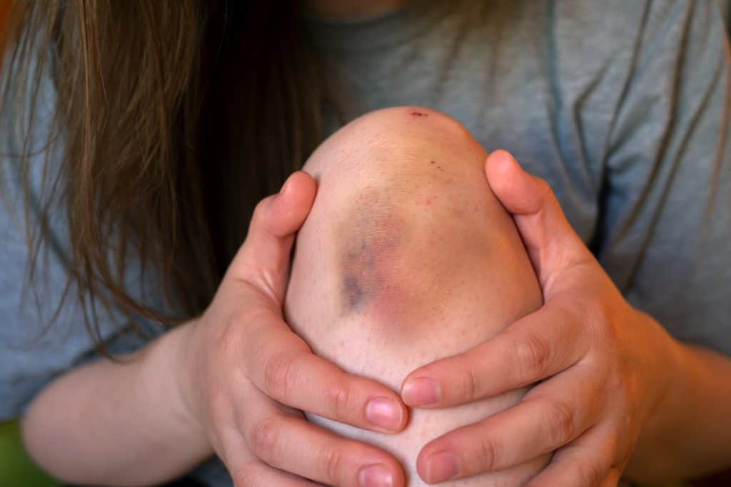 Što je kontuzija Što je kontuzija