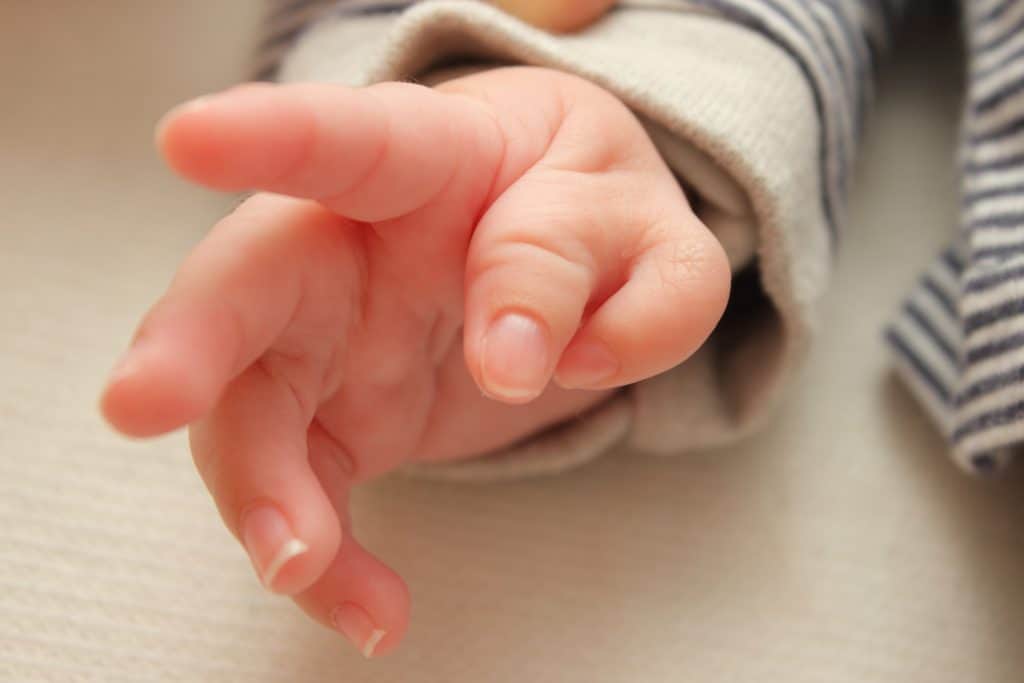 Što je polidaktilija