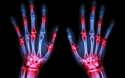Što je seronegativni artritis