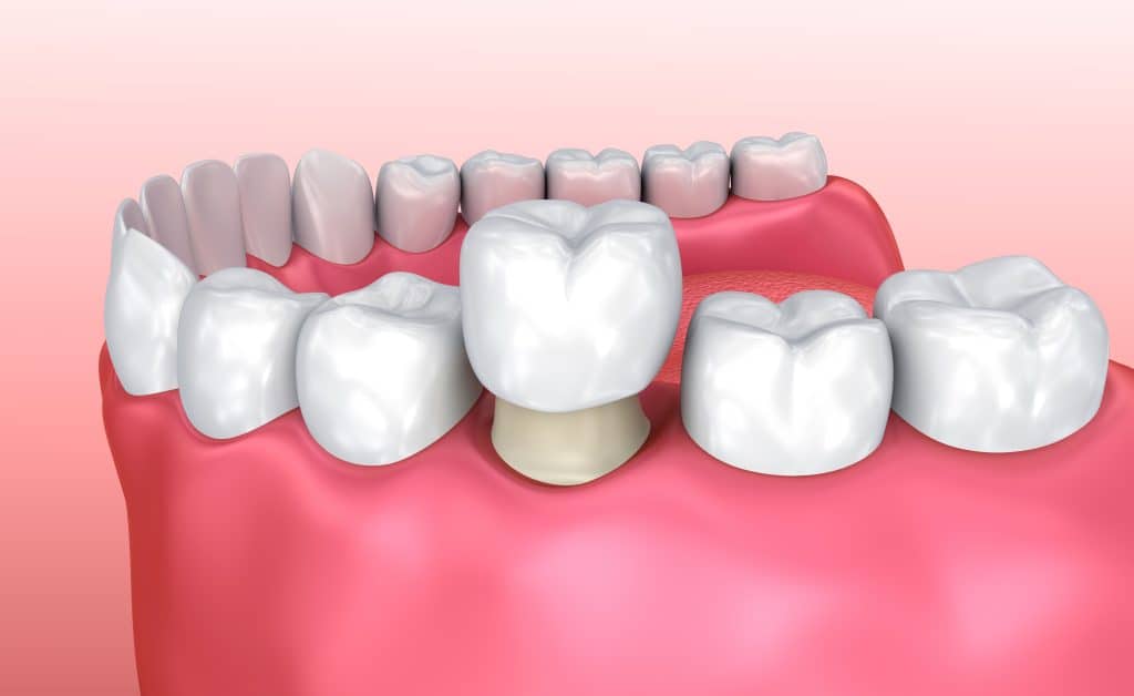 Što je zubna kruna