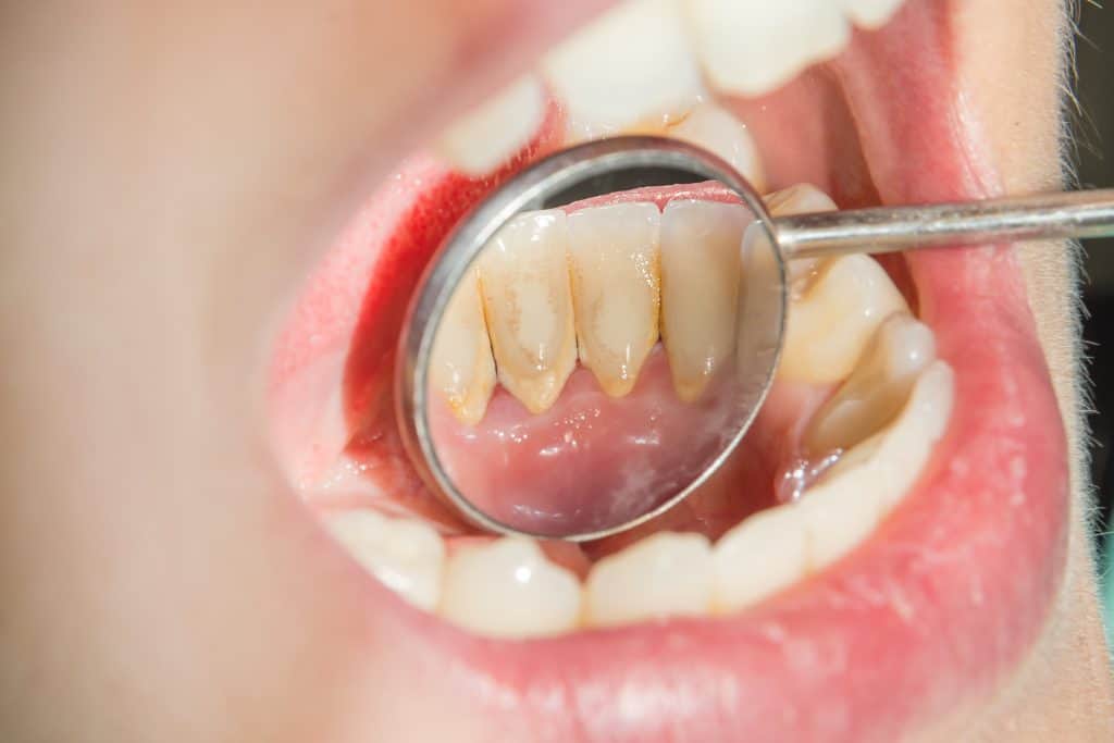 Što je zubni kamenac