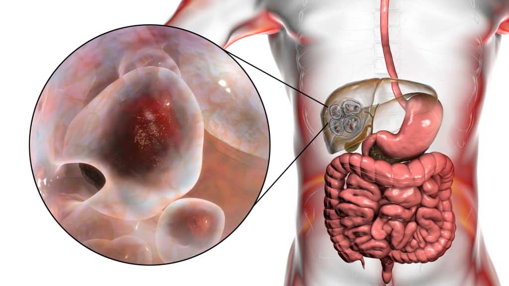 Ehinokokoza - uzrok, simptomi, liječenje