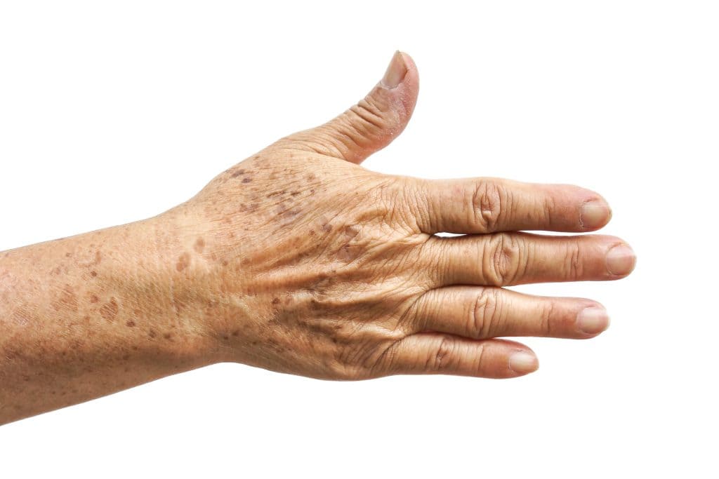 Kako skinuti staračke pjege sa ruku