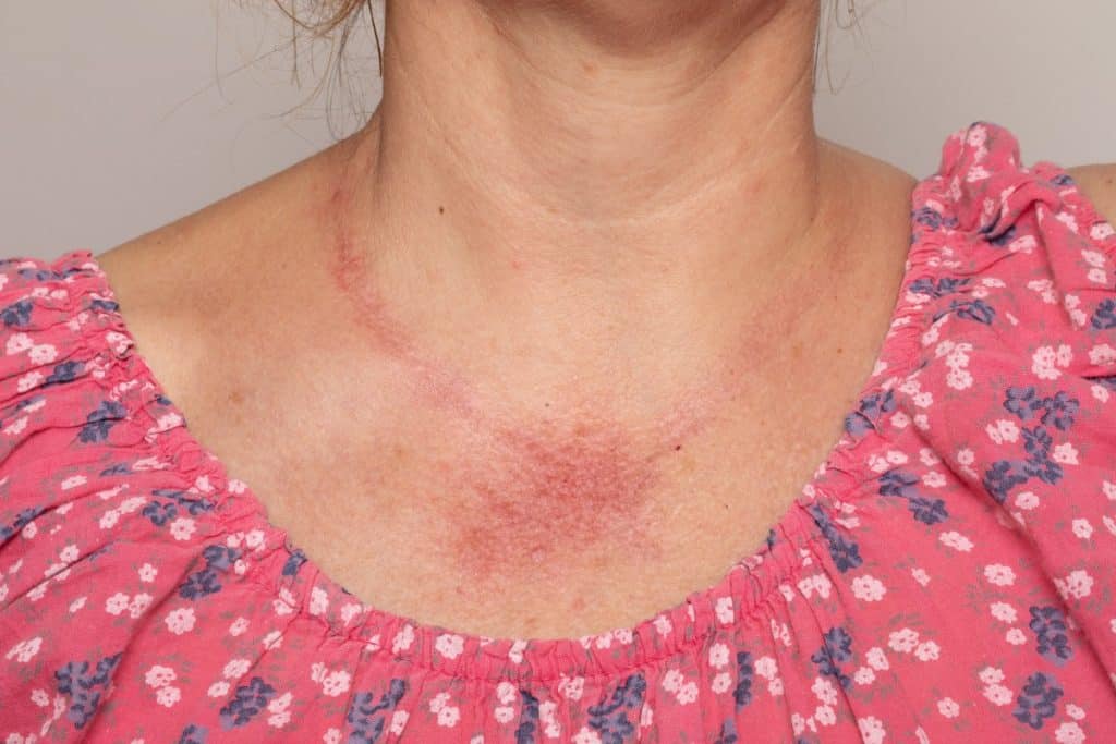 Alergija na nikal – uzroci, simptomi i liječenje