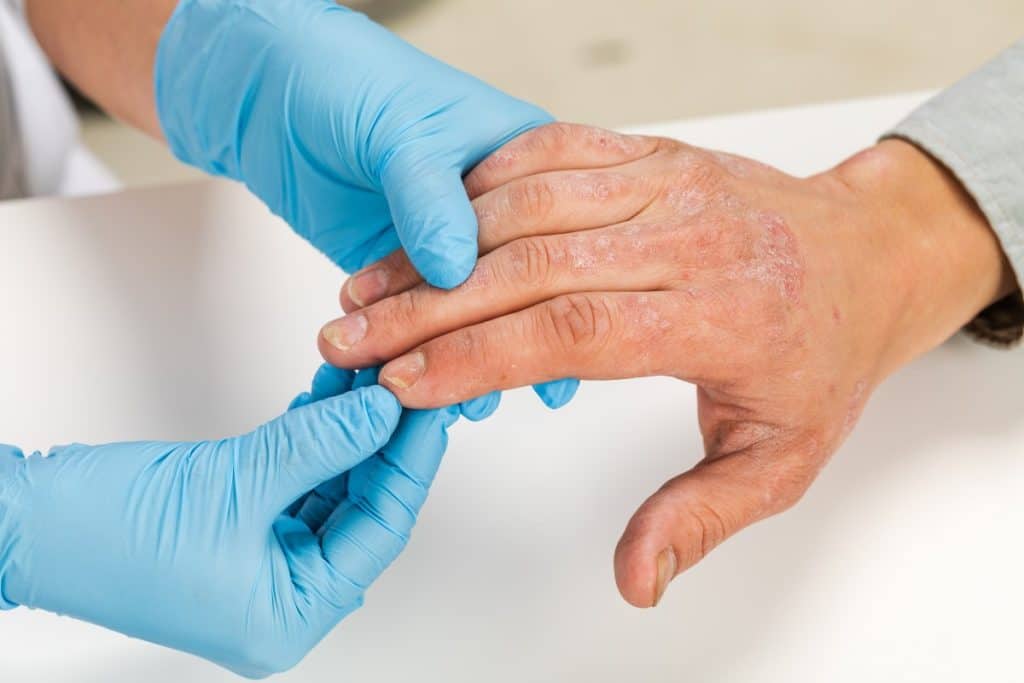 Alergijski dermatitis – uzroci, simptomi i liječenje